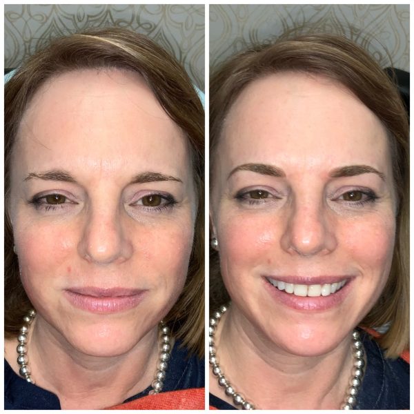 Digital Eyebrow Microblading Digital Eyebrow Microblading